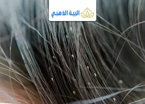 كيفية التخلص من بيض القمل